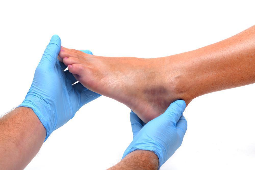 ankle sprain